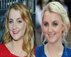 Evanna Lynch before surgery